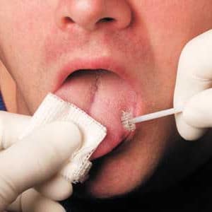 Biopsia de lesiones en cavidad oral