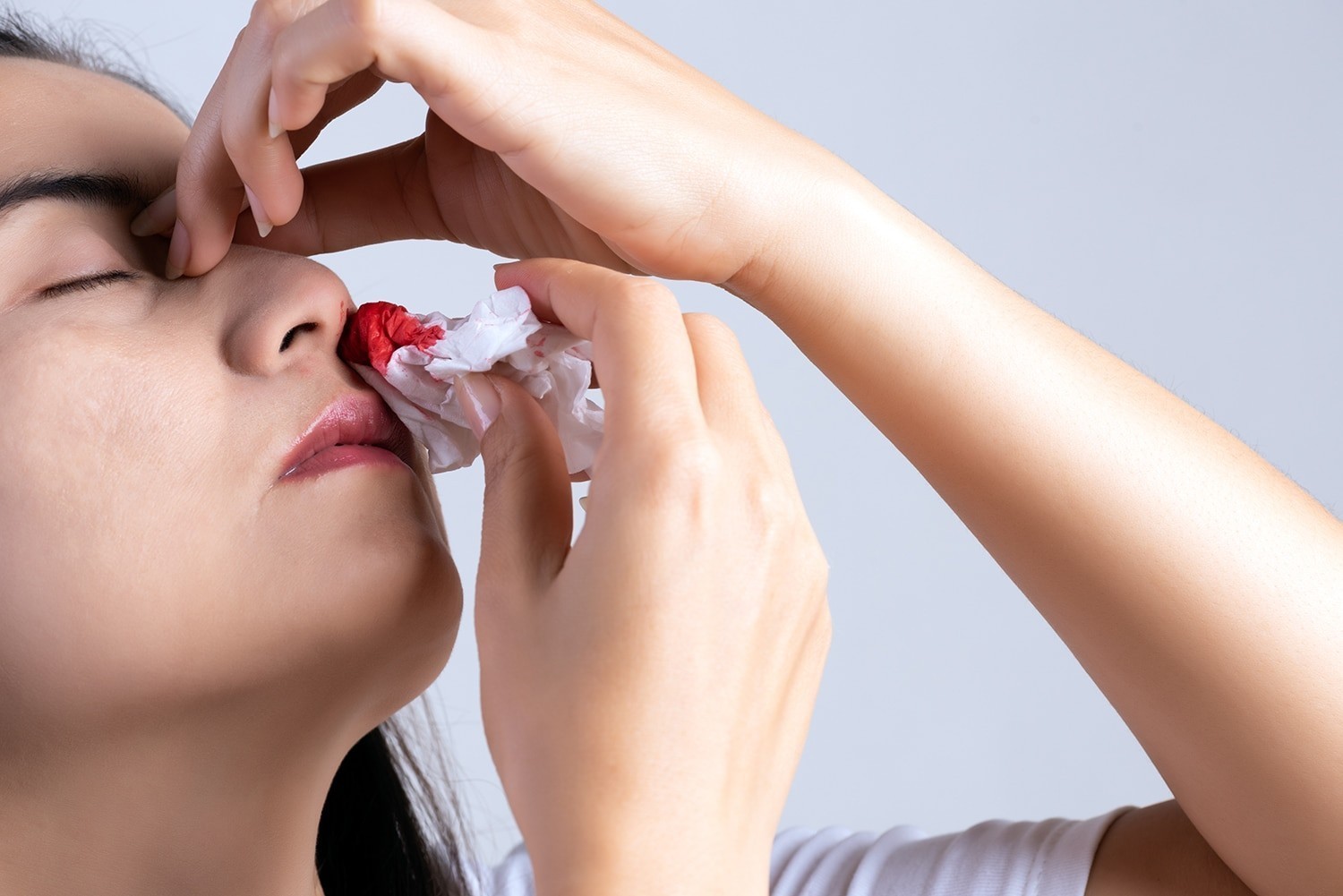 Cauterización de Vasos por epistaxis Cauterización de Vasos por epistaxis