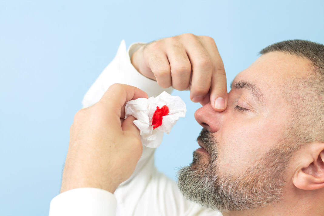Causas de una hemorragia nasal Causas de una hemorragia nasal